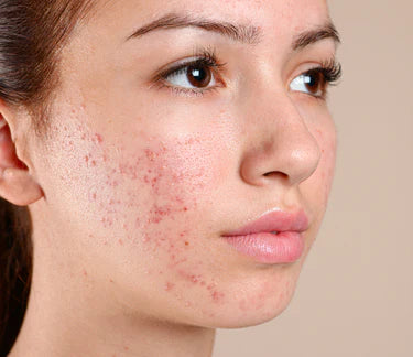 before using Sea Buckthorn oil 